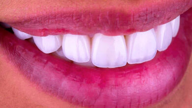 Are Veneers Right for You? Pros, Cons, and Cost in Turkey