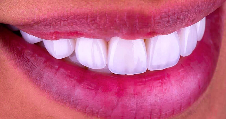 Are Veneers Right for You? Pros, Cons, and Cost in Turkey
